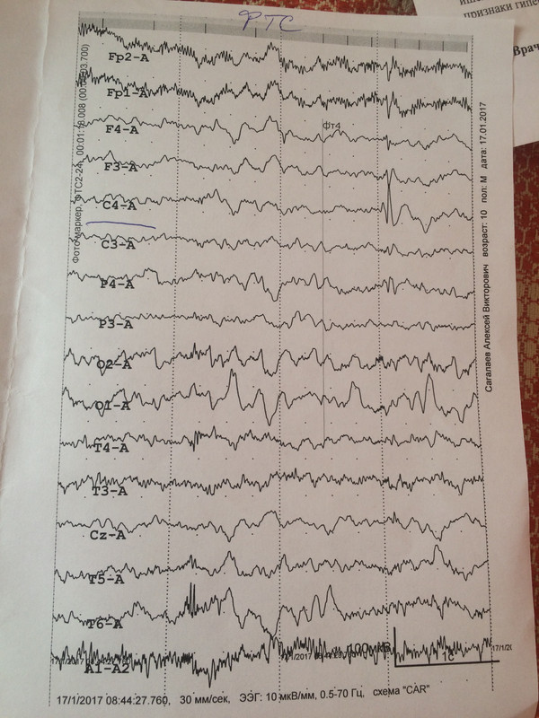 Ээг головного мозга результат. Электроэнцефалография (ЭЭГ) 31-канальная. ЭЭГ здорового человека развертка 30 мм/с. ЭЭГ здорового ребенка 1 год. МКВ В ЭЭГ это.